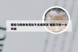 腹股沟两侧有类似牛皮癣斑状 腹股沟有一小块癣