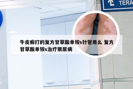 牛皮癣打的复方甘草酸单铵s针管用么 复方甘草酸单铵s治疗银屑病