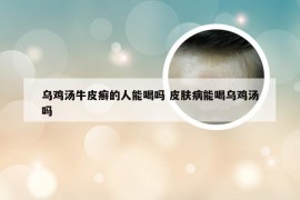 乌鸡汤牛皮癣的人能喝吗 皮肤病能喝乌鸡汤吗