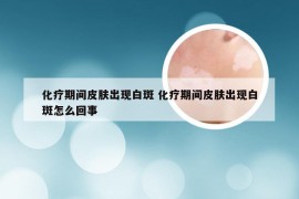 化疗期间皮肤出现白斑 化疗期间皮肤出现白斑怎么回事