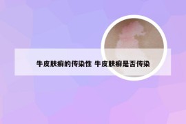 牛皮肤癣的传染性 牛皮肤癣是否传染