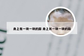 身上有一块一块的藓 身上长一块一块的藓