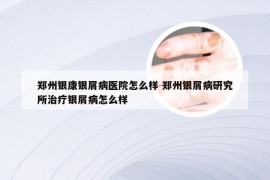 郑州银康银屑病医院怎么样 郑州银屑病研究所治疗银屑病怎么样