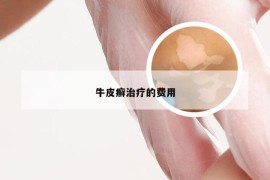 牛皮癣治疗的费用