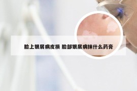 脸上银屑病皮损 脸部银屑病抹什么药膏