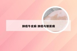 肺癌牛皮癣 肺癌与银屑病