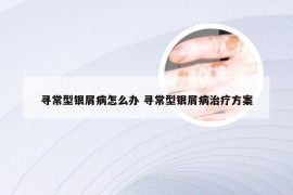 寻常型银屑病怎么办 寻常型银屑病治疗方案