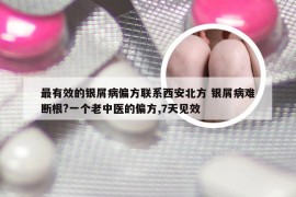 最有效的银屑病偏方联系西安北方 银屑病难断根?一个老中医的偏方,7天见效