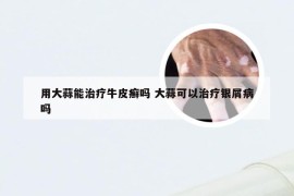 用大蒜能治疗牛皮癣吗 大蒜可以治疗银屑病吗