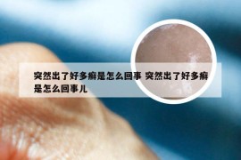 突然出了好多癣是怎么回事 突然出了好多癣是怎么回事儿