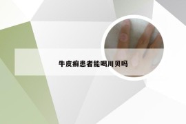 牛皮癣患者能喝川贝吗