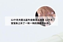 12个月大婴儿起牛皮癣怎么回事 12个月宝宝身上长了一块一块的像癣怎么办