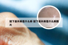 腿下面长癣是什么癣 腿下面长癣是什么癣图片