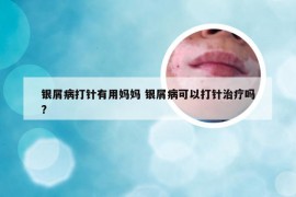 银屑病打针有用妈妈 银屑病可以打针治疗吗?
