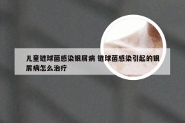 儿童链球菌感染银屑病 链球菌感染引起的银屑病怎么治疗