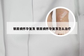 银屑病怀孕复发 银屑病怀孕复发怎么治疗