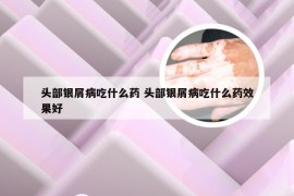 头部银屑病吃什么药 头部银屑病吃什么药效果好