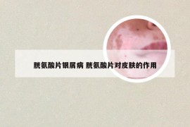 胱氨酸片银屑病 胱氨酸片对皮肤的作用