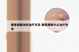 银屑病最快的治疗方法 银屑病有什么治疗办法