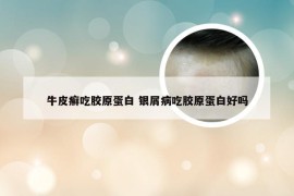 牛皮癣吃胶原蛋白 银屑病吃胶原蛋白好吗