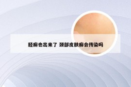 胫癣也出来了 颈部皮肤癣会传染吗