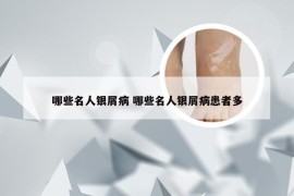 哪些名人银屑病 哪些名人银屑病患者多