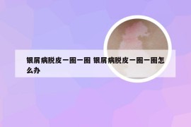 银屑病脱皮一圈一圈 银屑病脱皮一圈一圈怎么办