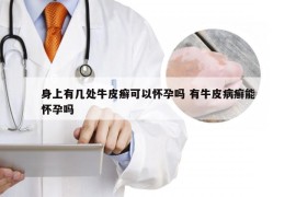 身上有几处牛皮癣可以怀孕吗 有牛皮病癣能怀孕吗