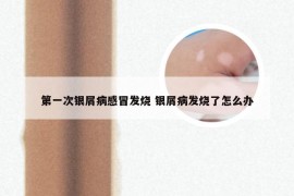 第一次银屑病感冒发烧 银屑病发烧了怎么办