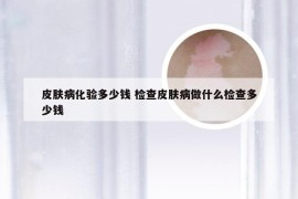 皮肤病化验多少钱 检查皮肤病做什么检查多少钱