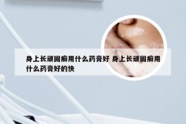 身上长顽固癣用什么药膏好 身上长顽固癣用什么药膏好的快