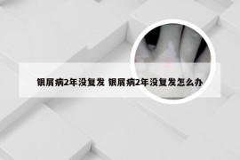 银屑病2年没复发 银屑病2年没复发怎么办
