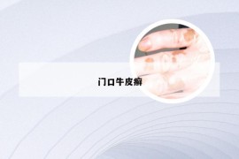 门口牛皮癣