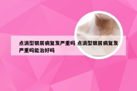 点滴型银屑病复发严重吗 点滴型银屑病复发严重吗能治好吗