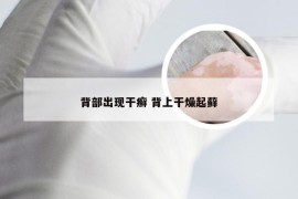 背部出现干癣 背上干燥起藓
