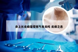 身上长皮癣是受寒气有关吗 皮癣之患
