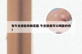 有牛皮癣能和赖氨酸 牛皮肤癣可以喝酸奶吗?