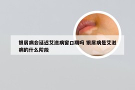 银屑病会延迟艾滋病窗口期吗 银屑病是艾滋病的什么阶段