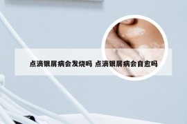 点滴银屑病会发烧吗 点滴银屑病会自愈吗
