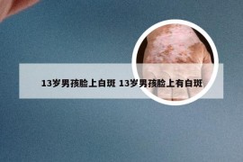 13岁男孩脸上白斑 13岁男孩脸上有白斑