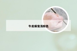 牛皮癣变浅粉色