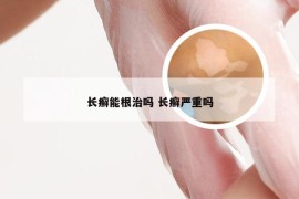 长癣能根治吗 长癣严重吗