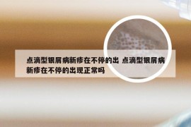 点滴型银屑病新疹在不停的出 点滴型银屑病新疹在不停的出现正常吗
