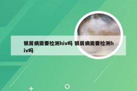 银屑病需要检测hiv吗 银屑病需要检测hiv吗