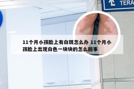 11个月小孩脸上有白斑怎么办 11个月小孩脸上出现白色一块块的怎么回事
