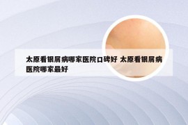 太原看银屑病哪家医院口碑好 太原看银屑病医院哪家最好
