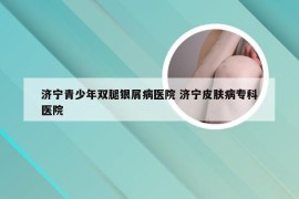 济宁青少年双腿银屑病医院 济宁皮肤病专科医院