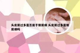 头皮屑过多是否属于银屑病 头皮屑过多是银屑病吗