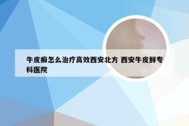 牛皮癣怎么治疗高效西安北方 西安牛皮鲜专科医院