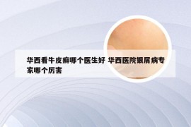 华西看牛皮癣哪个医生好 华西医院银屑病专家哪个厉害